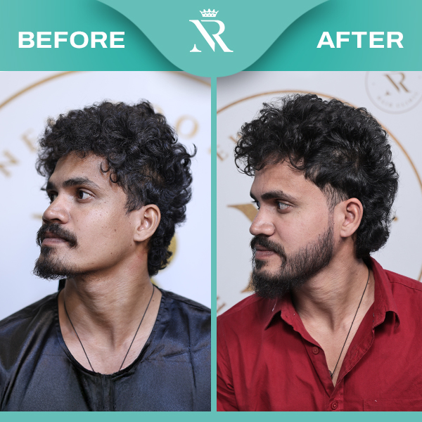 Beard-Hair-Transplant_Result-Jan-2026_01